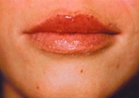 Skin Treatments - After Treatment Photos - female, front view, patient 3 (lips)