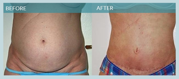 A Mini Tummy Tuck in NYC with Dr. Elliot Jacobs