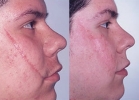 Skin Treatments - Before and After Treatment Photos - female, right side view, patient 1 (face)