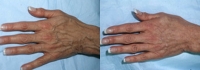 Skin Treatments - Before and After Treatment Photos - female, top view, patient 2 (hands)