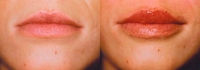 Skin Treatments - Before and After Treatment Photos - female, front view, patient 3 (lips)