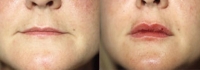 Skin Treatments - Before and After Treatment Photos - female, front view, patient 4 (lips)